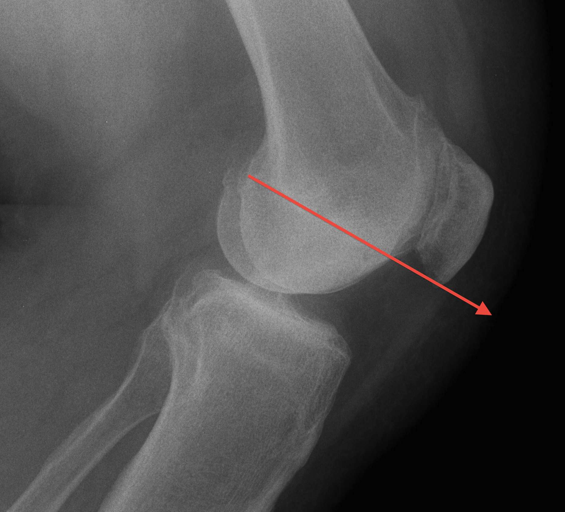 Patella Height Normal Blumensaat's Line